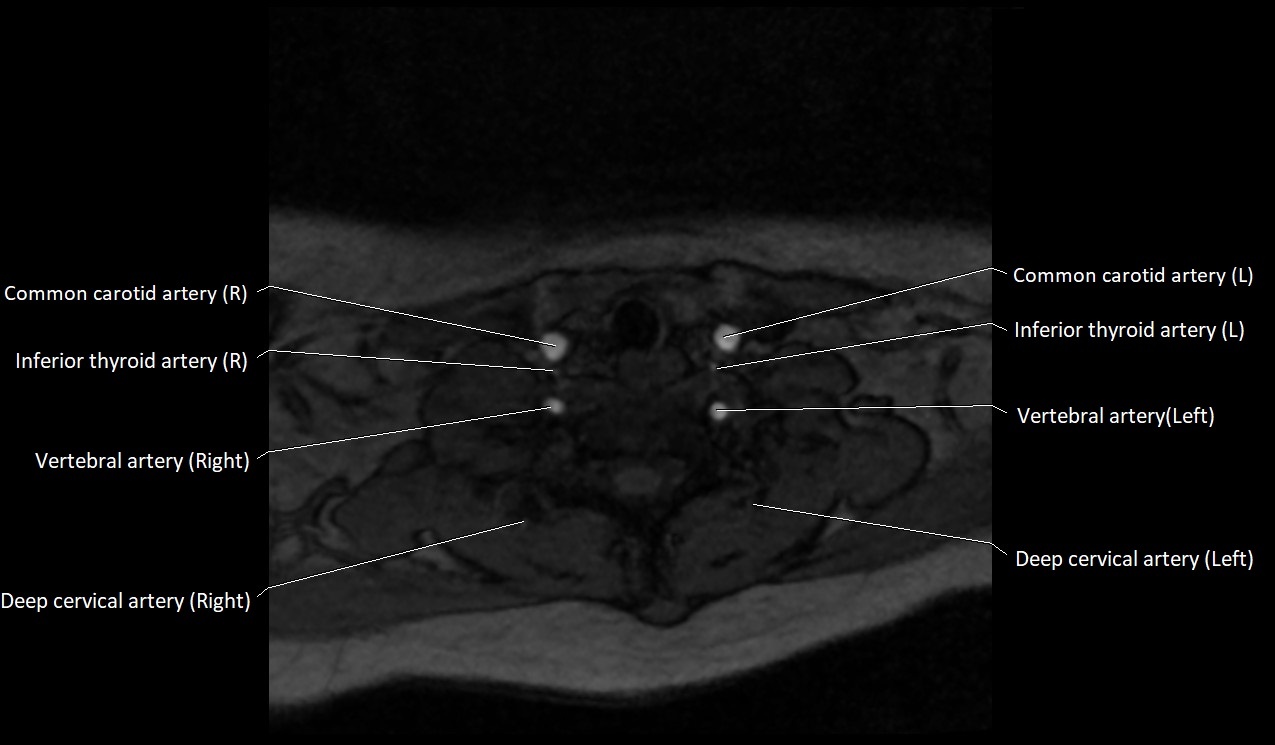 Carotid artery anatomy axial 3T image 58.jpg